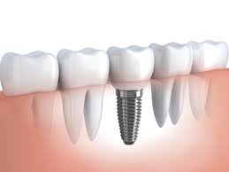 When Should You Consider Dental Implants?