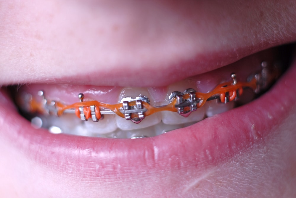 What is a power chain for braces for benefits?