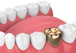 What You Should Know About the Beauty Gold Tooth Crowns