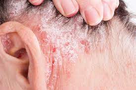 Managing Psoriasis