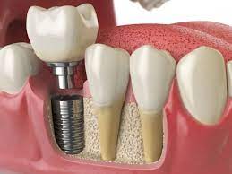 What Are the Dental Implant Side Effects?|Dental implant