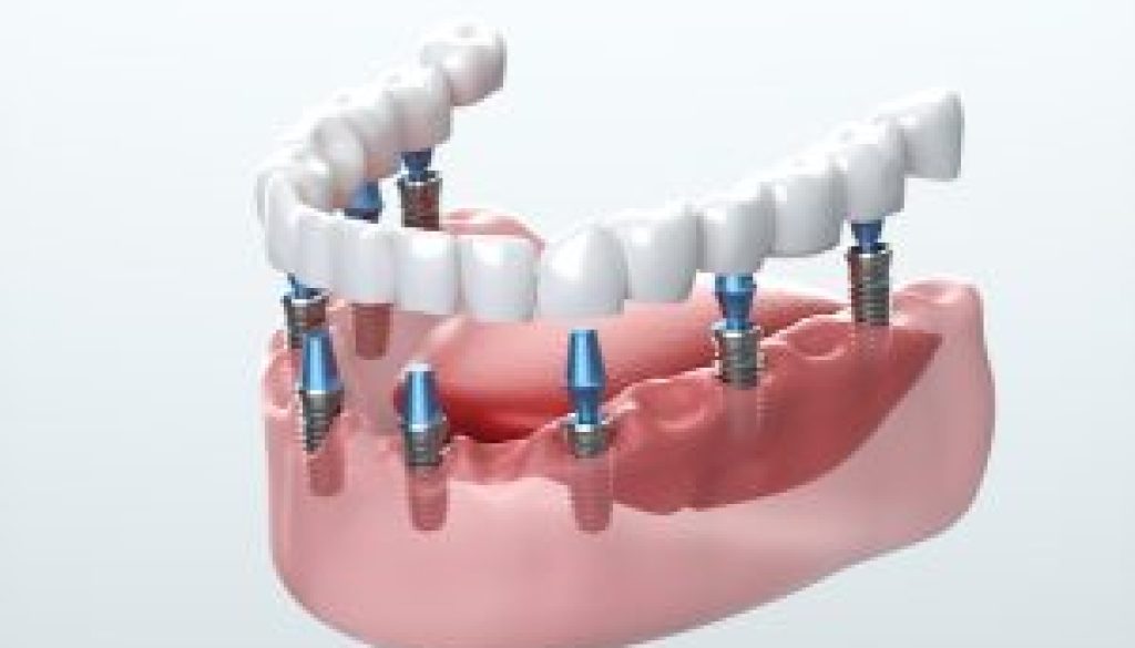 dental Implants Barrow