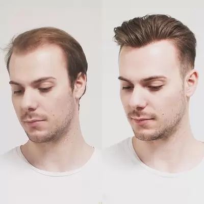 Best Hair Transplant in Pakistan