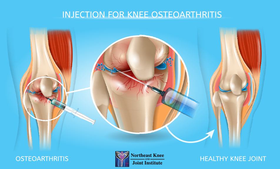 Breaking Down Barriers: Hyaluronic Acid Injections Knee Cost