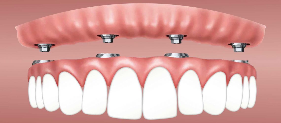 Dental Implants in Dumfries: A Complete Guide to Restoring Your Smile