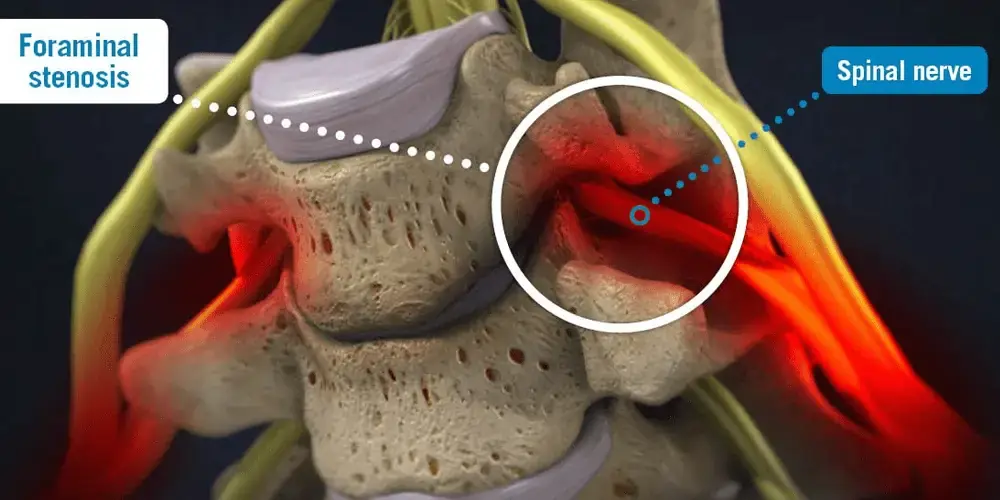 Navigating Foraminal Stenosis: Causes, Symptoms, and Treatments