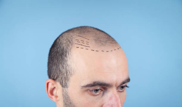 Hair transplant cost in Dubai