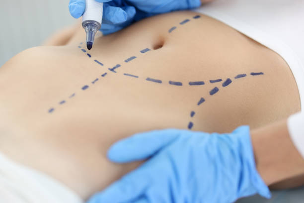 “Decoding Liposuction: A Comprehensive Guide to the Procedure in Dubai”