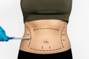 Liposuction surgery in Dubai