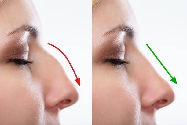 “Decoding the Elegance: Rhinoplasty Trends in Dubai”