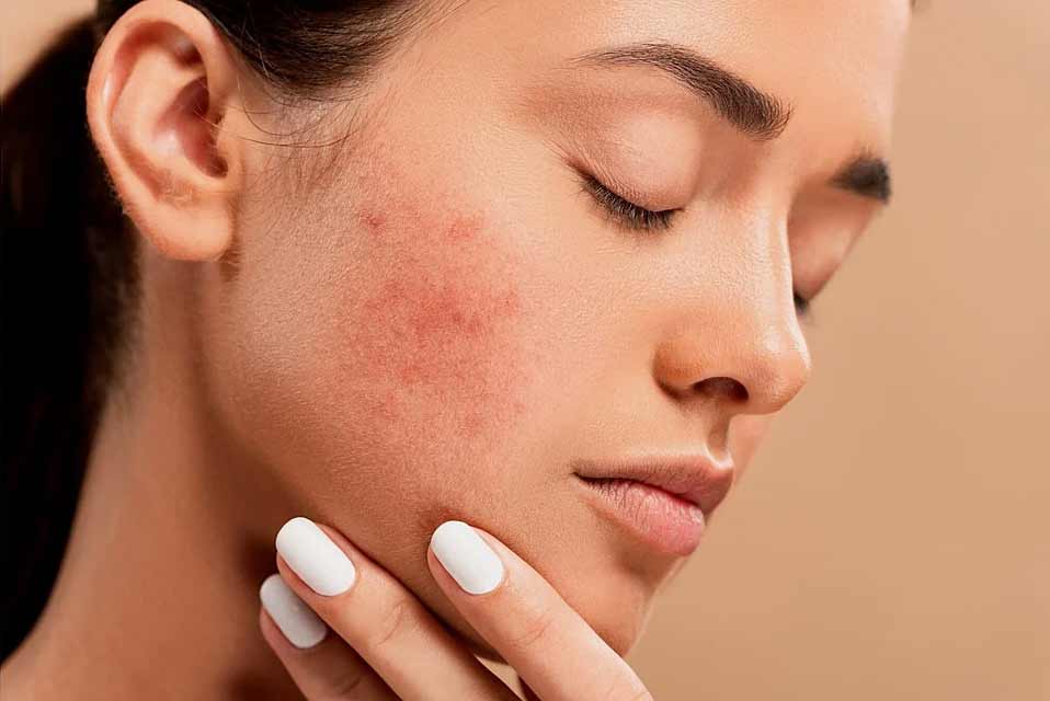 Acne-Free Dubai & Abu Dhabi: Expert Tips