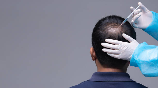 Protecting The Scalp From Hair Damage Through Hair Transplant