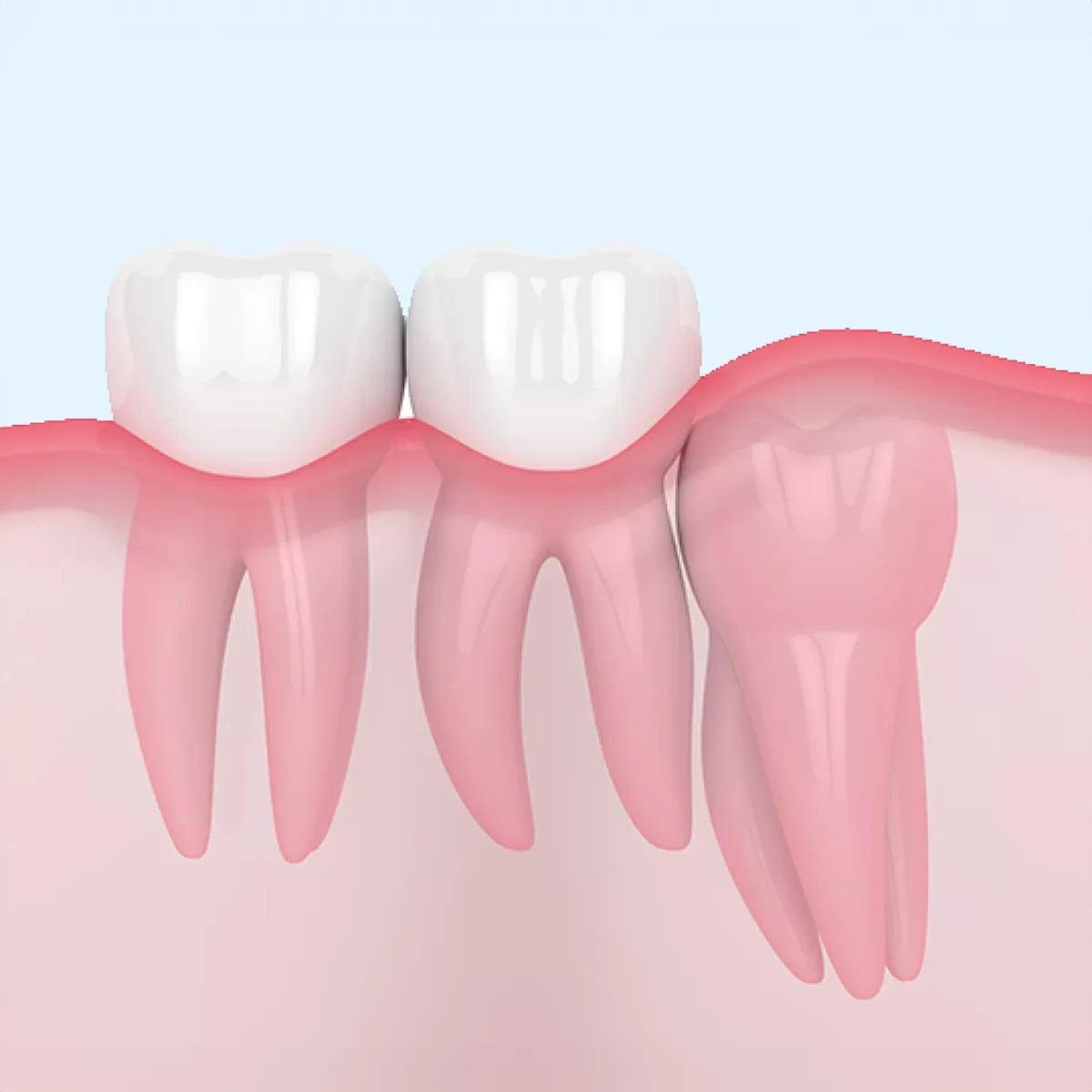 wisdom Tooth Extraction in dubai