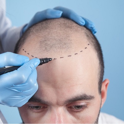 Deciphering Hair Transplant Treatment and Costs in Islamabad