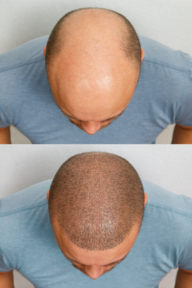 Choosing the Right Hair Transplant Surgeon