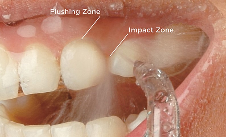 Is Water Flossing Effective