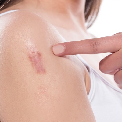 Scars & Keloid Treatment in Islamabad