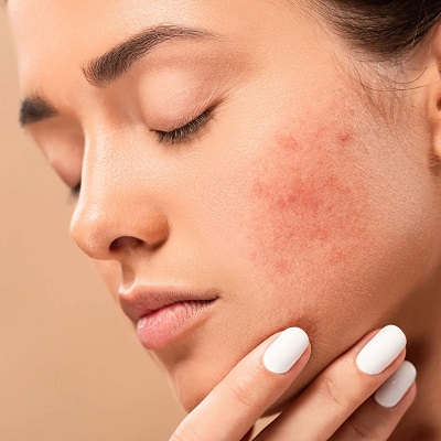 Erasing the Marks: A Comprehensive Guide to Treating Acne Scars 