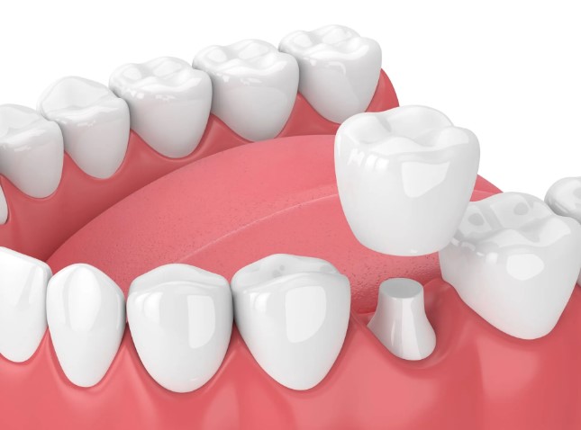 What is Veneer Teeth, and How Does the Treatment Work?