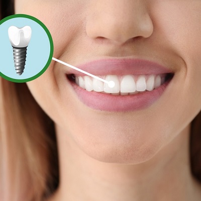 Reclaiming Your Smile: A Comprehensive Exploration of Dental Implant Treatment