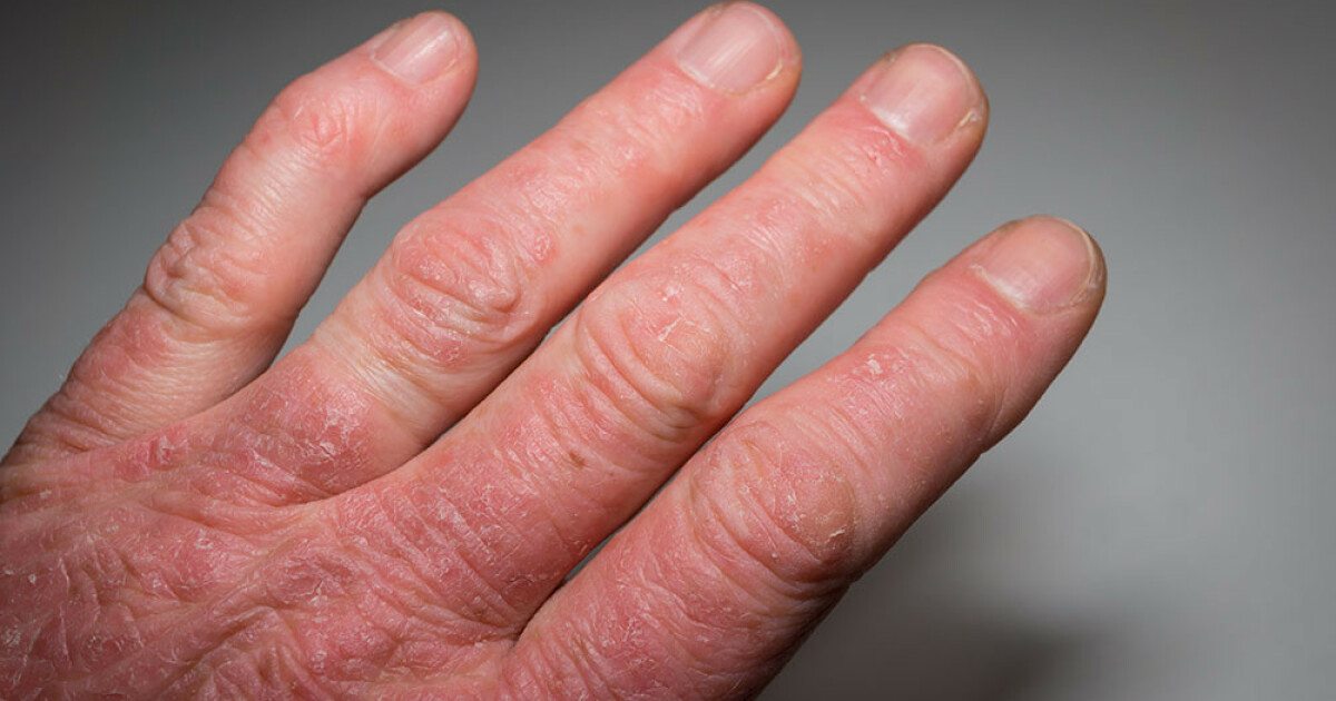 eczema insight