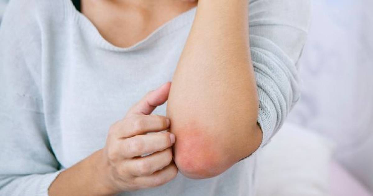 eczema insight