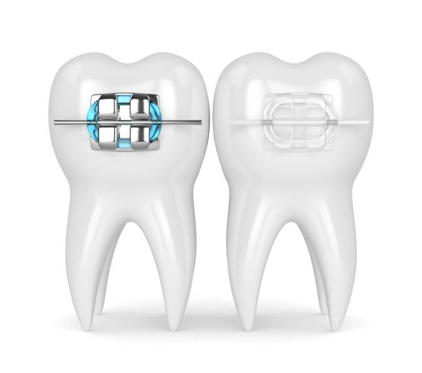 Ceramic Braces vs Metal Braces: Everything You Need to Know