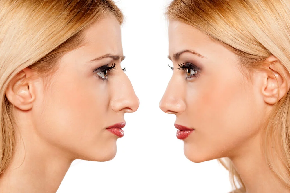 Beyond Wrinkles: Rediscovering Beauty with Stem Cell Face Lifts in Riyadh