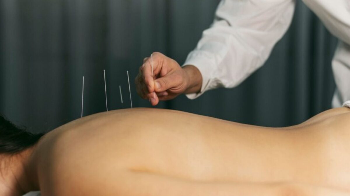 A doctor doing acupuncture therapy on a female back