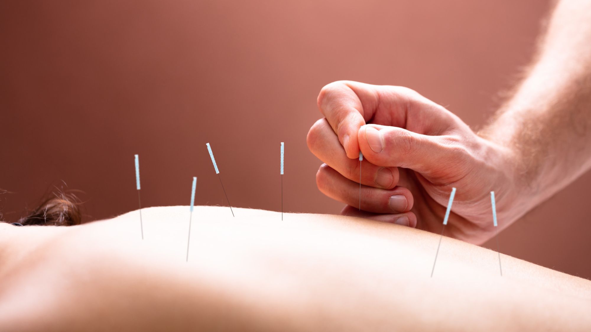 A doctor doing acupuncture therapy on a female back with needles