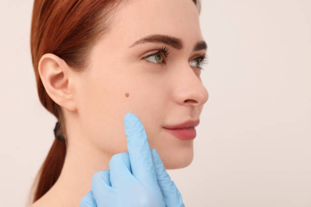 Renew Confidence: Birthmark Removal Treatment in Riyadh