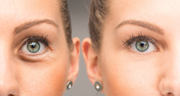 Blepharoplasty in Riyadh