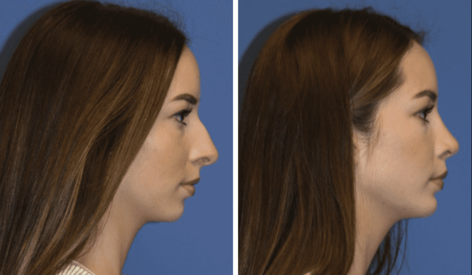 Unveiling Confidence: Exploring the World of Chin Augmentation