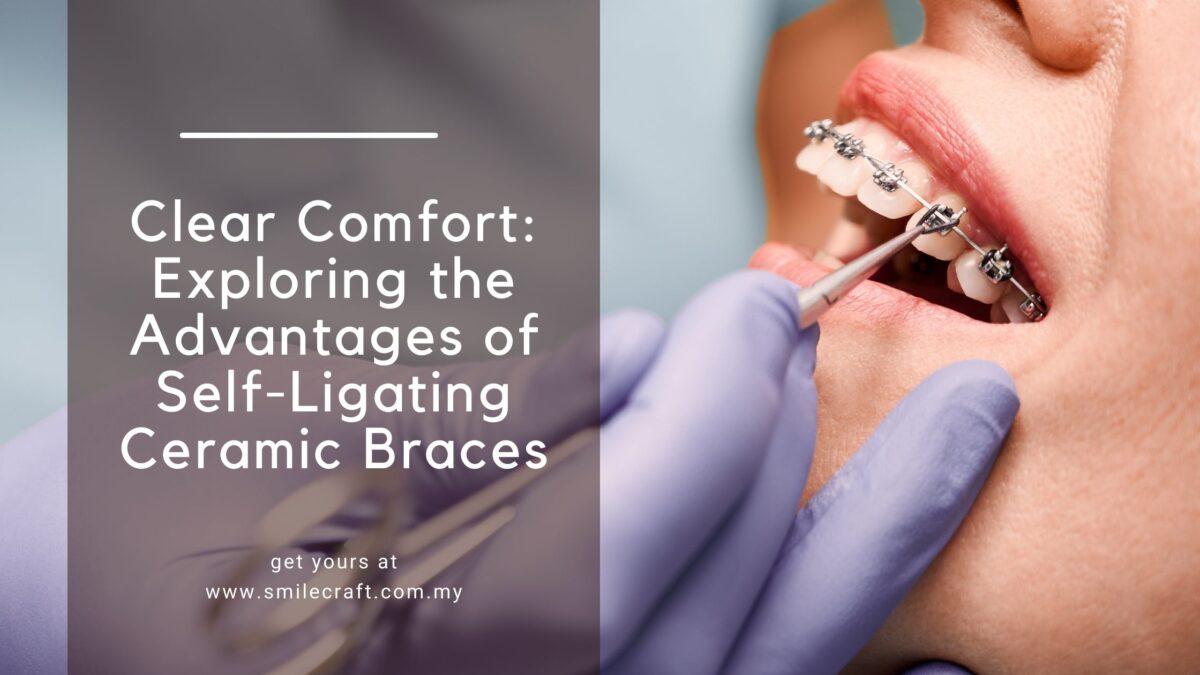 Clear Comfort: Exploring the Advantages of Self-Ligating Ceramic Braces