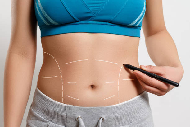 Achieve Your Dream Body: Abdominoplasty in Riyadh