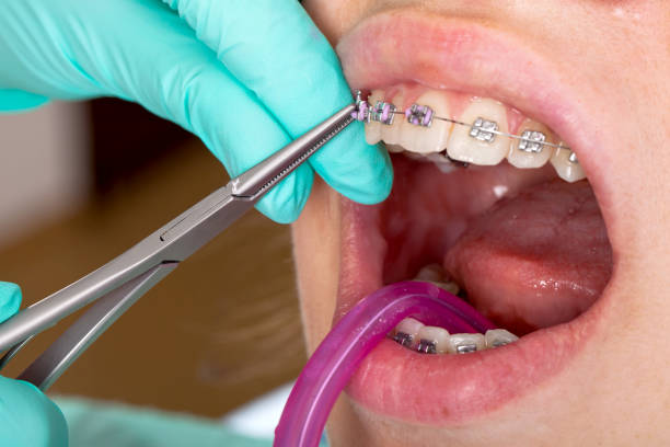 Transform Your Smile: Best Teeth Straightening Alignment in Riyadh