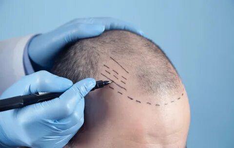 Counting the Strands: Decoding Hair Transplant Costs in Dubai