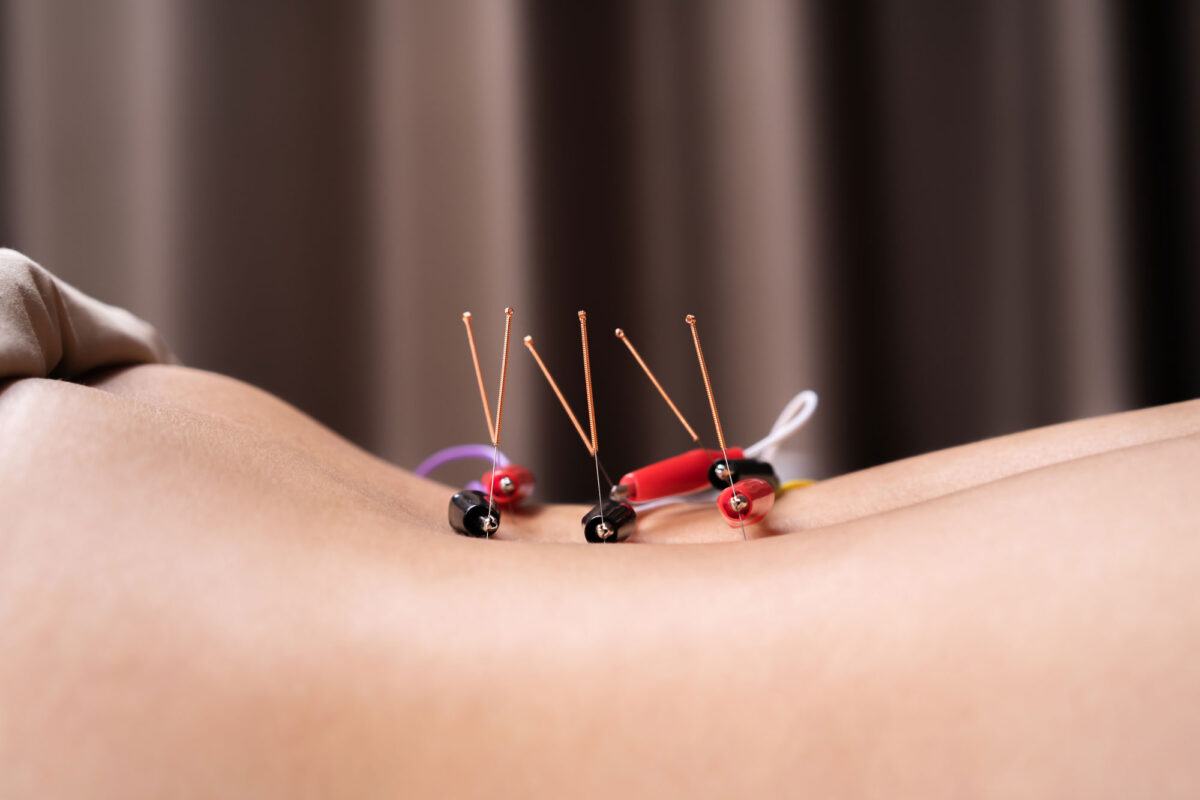 LASER ACUPUNCTURE