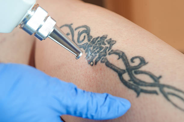 Effective Solutions for Tattoo Removal: Paper Methods in Riyadh