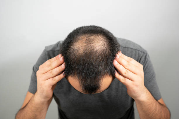 Hair Transplant in Islamabad: Your Path to Restoring Hair and Confidence