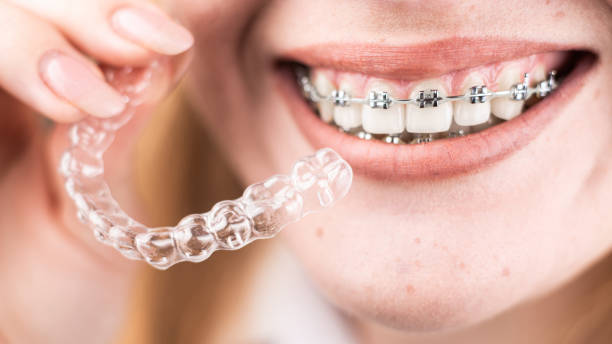 The Ultimate Guide to Dental Braces: Your Path to a Perfect Smile