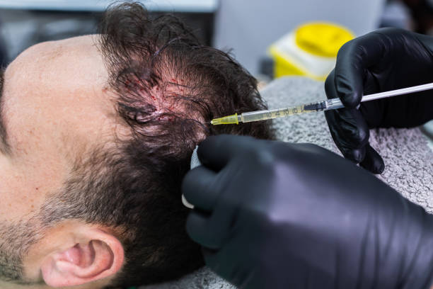 PRP Hair Treatment: A Revolutionary Approach to Hair Loss