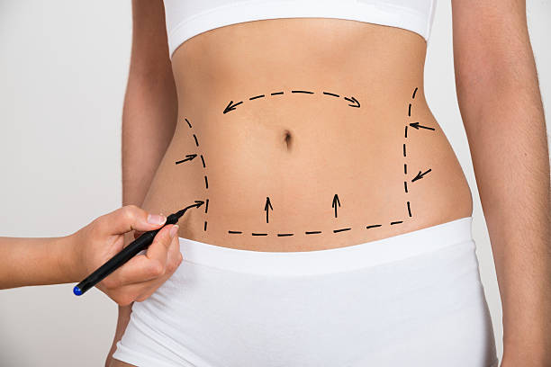 Navigating Liposuction in Riyadh: What You Need to Know