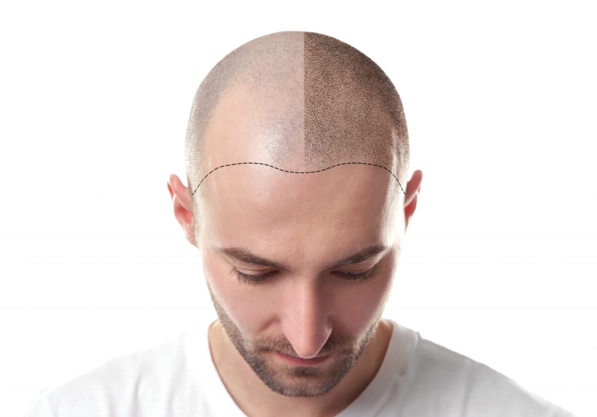 Before and After: Scalp Micropigmentation Transformations