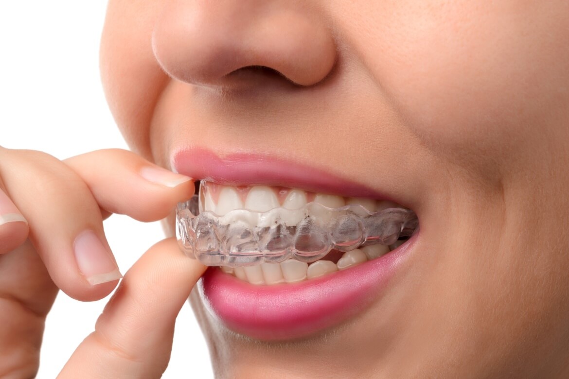 Invisalign Cardiff