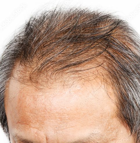 Male Baldness Cure: Overcome Hair Loss with Advanced Hair Systems