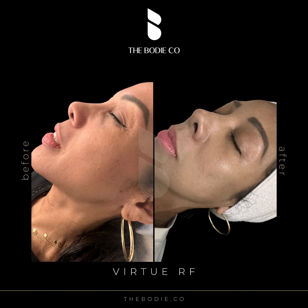 Unlock Glowing Skin with NYC Microneedling: Your Ultimate Guide to a Youthful Transformation