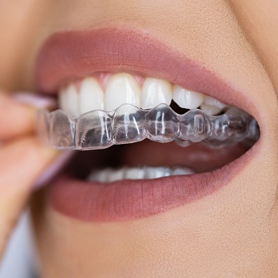 Comprehensive Guide to Caring for Your Dental Retainers