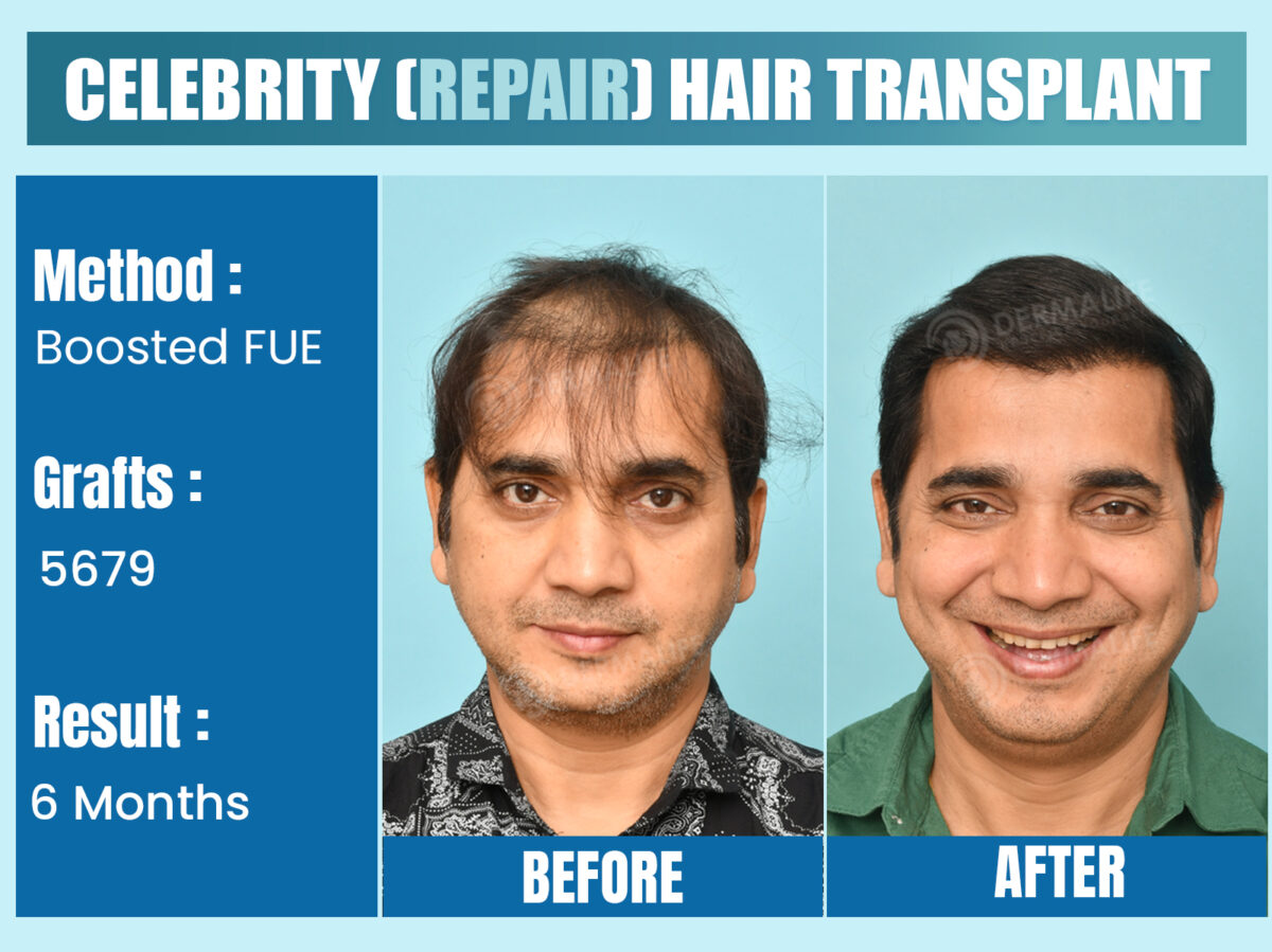 Is it Possible to Get a Cost-Effective Hair Transplant in Delhi?