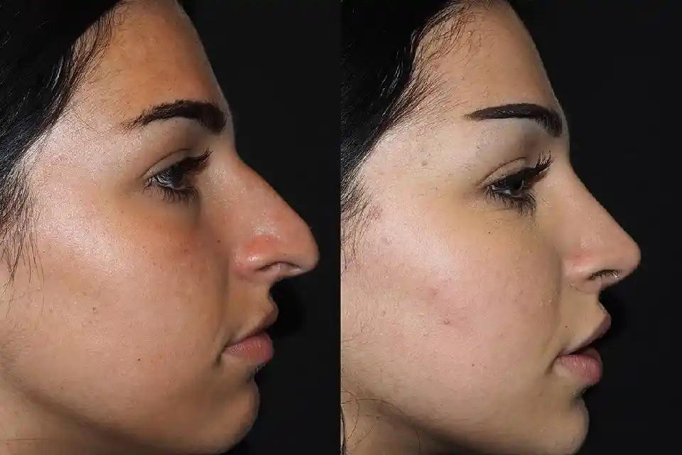 Rhinoplasty in Dubai: Balancing Your Facial Features